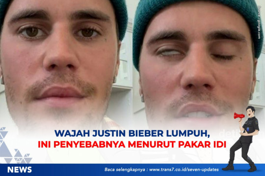 Wajah Justin Bieber Lumpuh, Ini Penyebabnya Menurut Pakar IDI